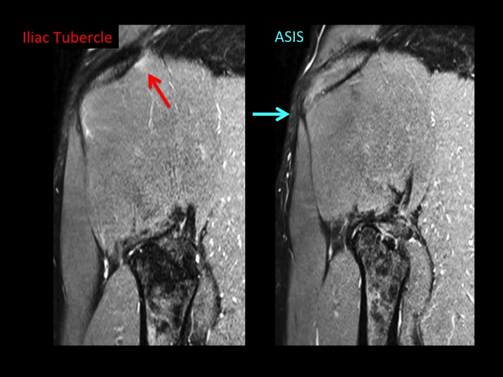 Figure 3 for case iliotibial band ( RID2855 )